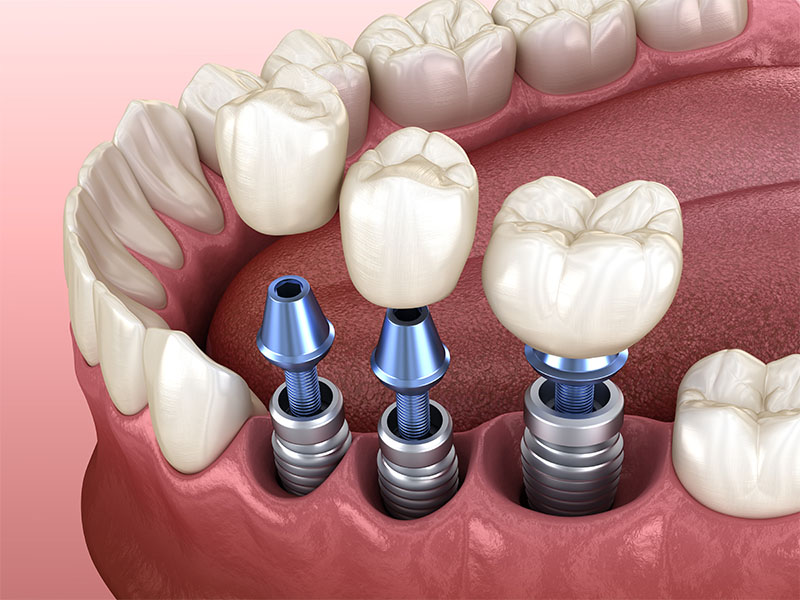 Keramikimplantate in Euskirchen